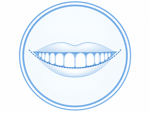 Smile Arc diagram showing the natural curvature of upper teeth following the lower lip line